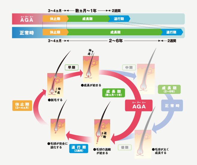 男性ホルモンの悪影響によるヘアサイクルの通常との比較図