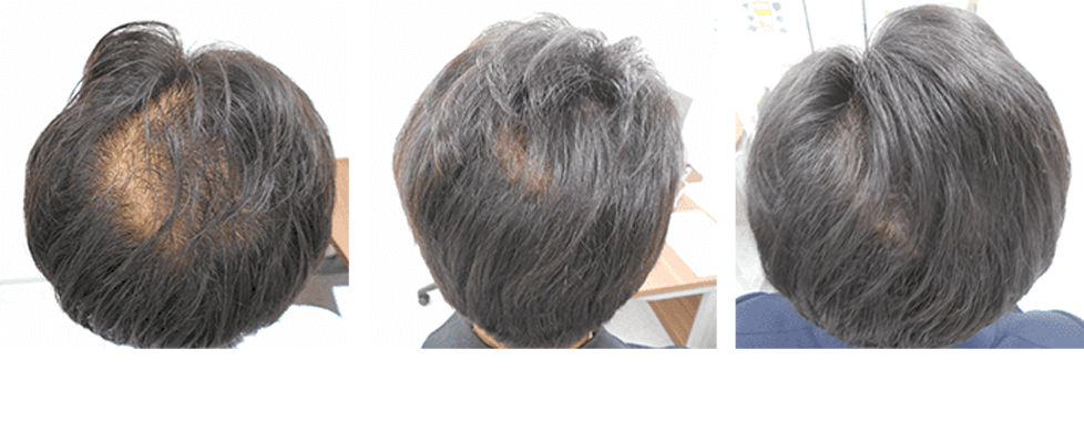 治療開始前・治療一年目