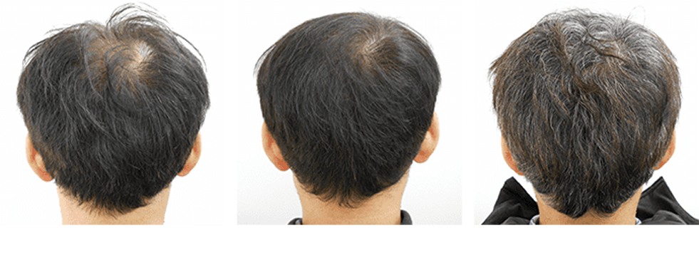 治療開始前・治療3ヶ月目