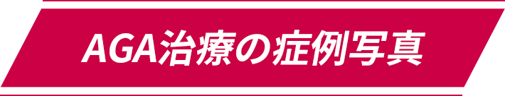 AGA治療の症例写真