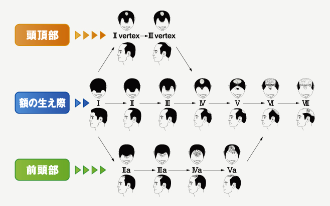 タイプ別薄毛の種類の図