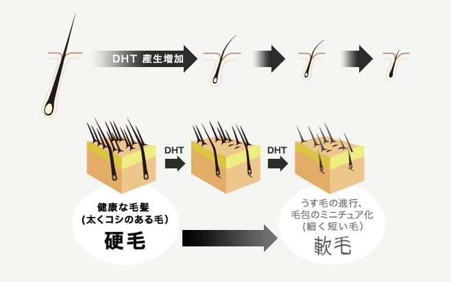 ホルモンによって薄毛になっていくイメージ図