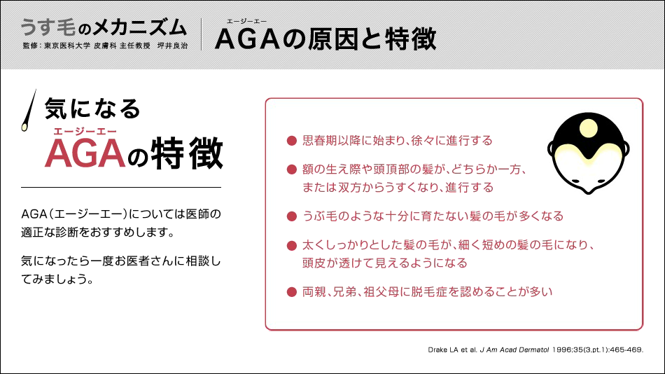 東京医科大学皮膚科主任、坪井良治教授慣習による、AGAの原因と特徴について